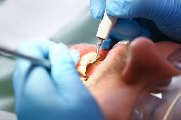 Best Emergency Root Canal Treatment in Fort Lewis, WA