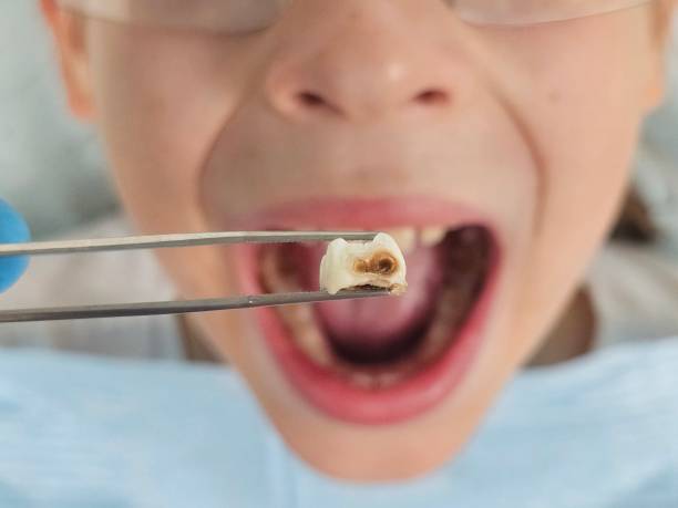 Best Same-Day Emergency Dentist in Fort Lewis, WA